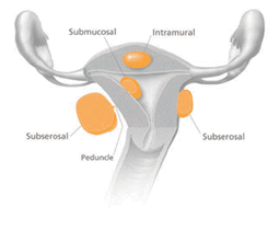 Fibroids, infertility and IVF success